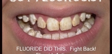 Small2_got_fluorosis_fight_back